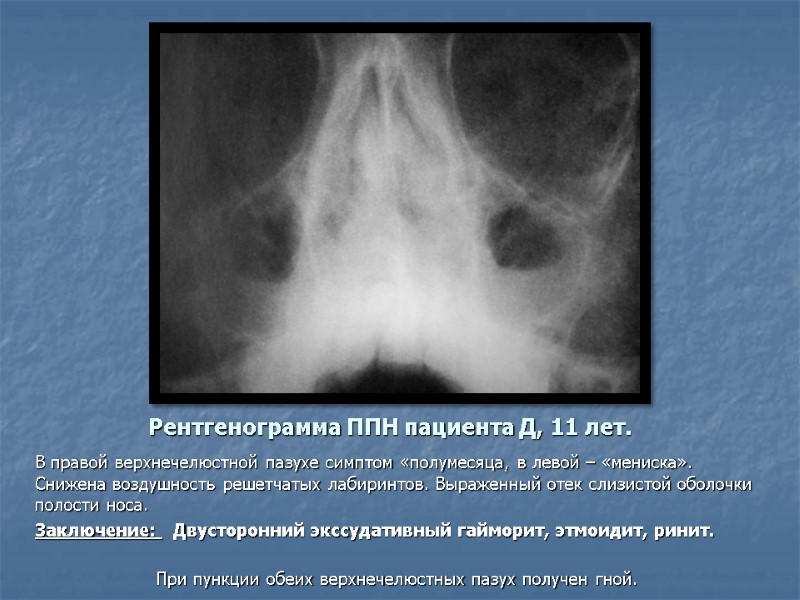 Рентгенограмма ППН пациента Д, 11 лет. В правой верхнечелюстной пазухе симптом «полумесяца, в левой